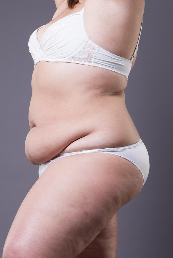 Tummy Tuck & Abdominoplasty, Plastic Surgery