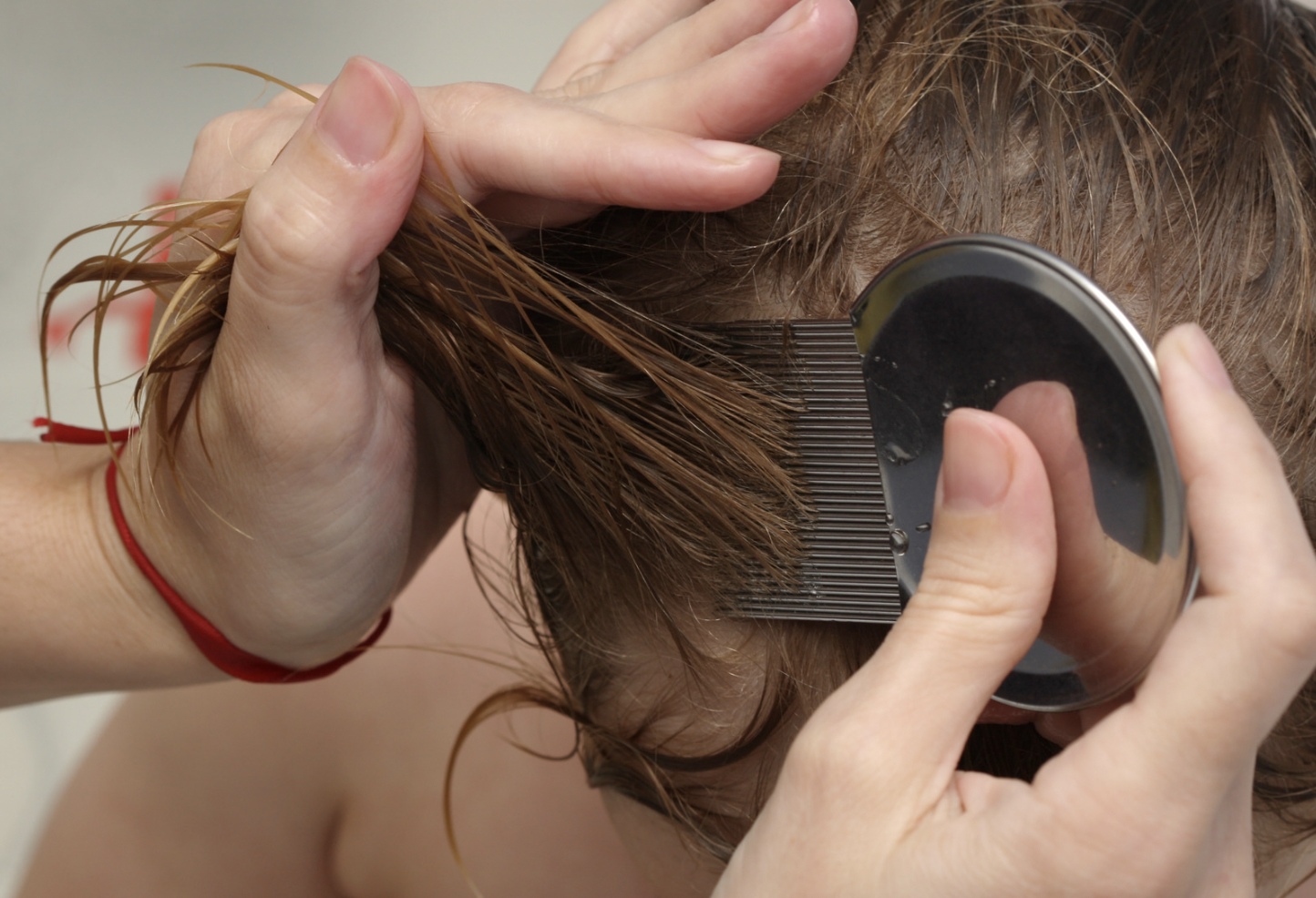 dermatology surgery associates using comb for head lice bronx ny