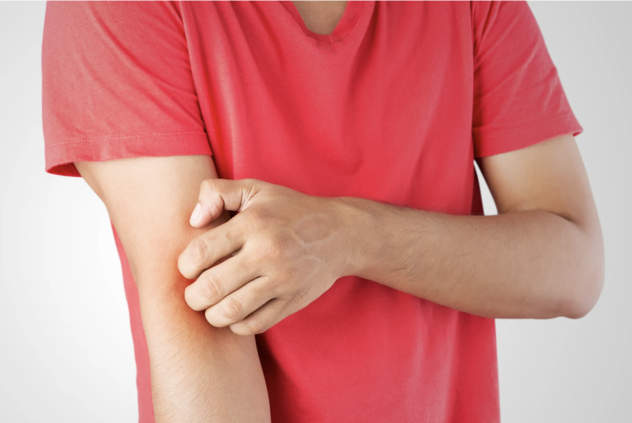 Intertrigo Treatment Options Dermatology Bronx, NYC