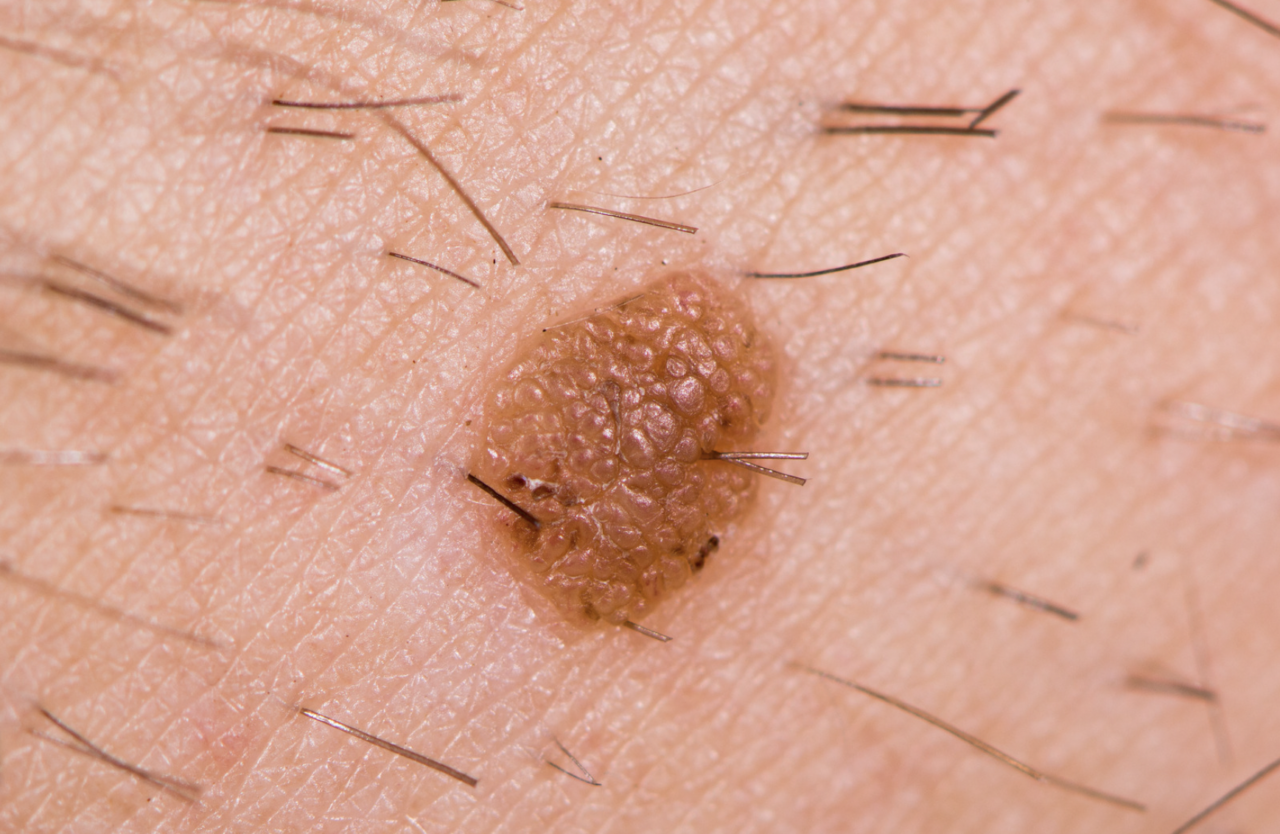 Comprehensive Seborrheic Keratosis Guide Bronx, NYC