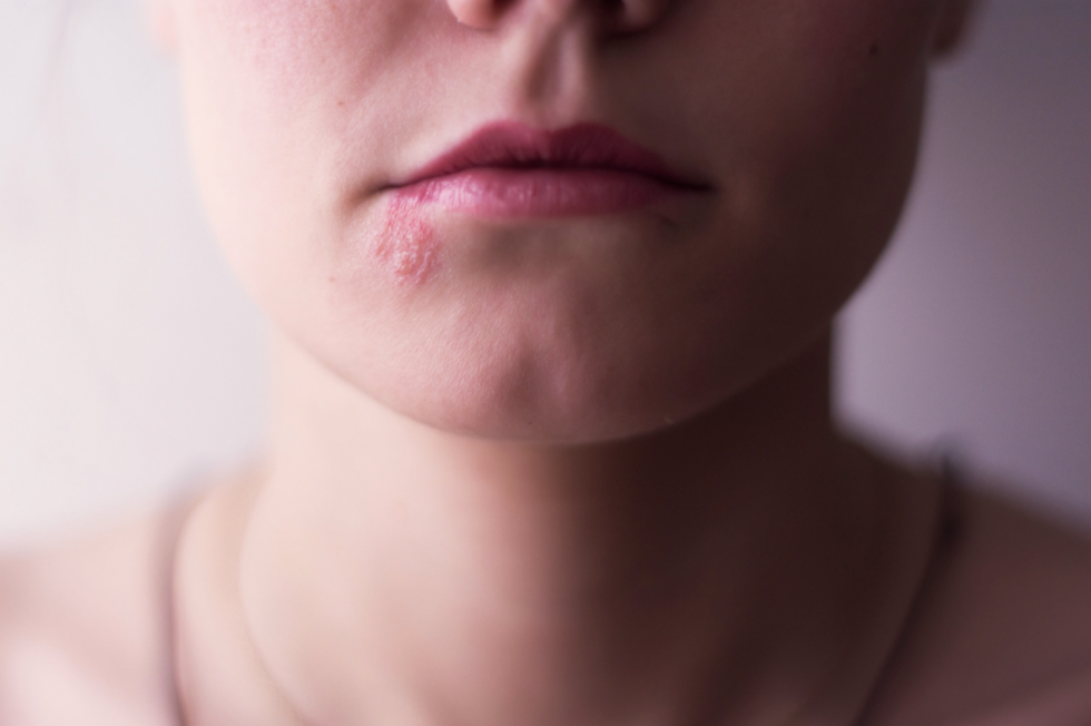 Herpes Simplex Treatment Options Bronx, NYC