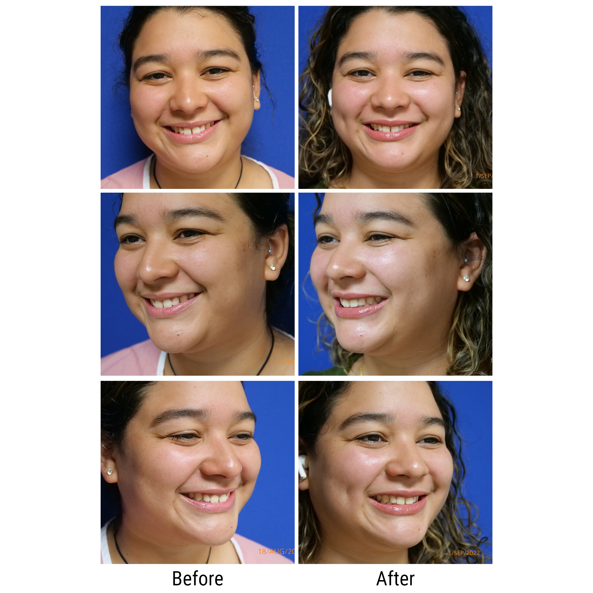 Dimples Guide & Treatments Plastic Surgery Bronx, NYC