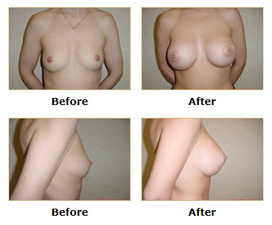 dermatology and surgery associates breast augmentation before and after bronx ny