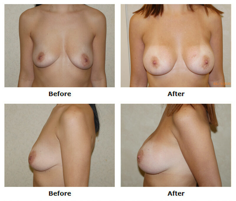 dermatology and surgery associates breast augmentation 2 before and after bronx ny