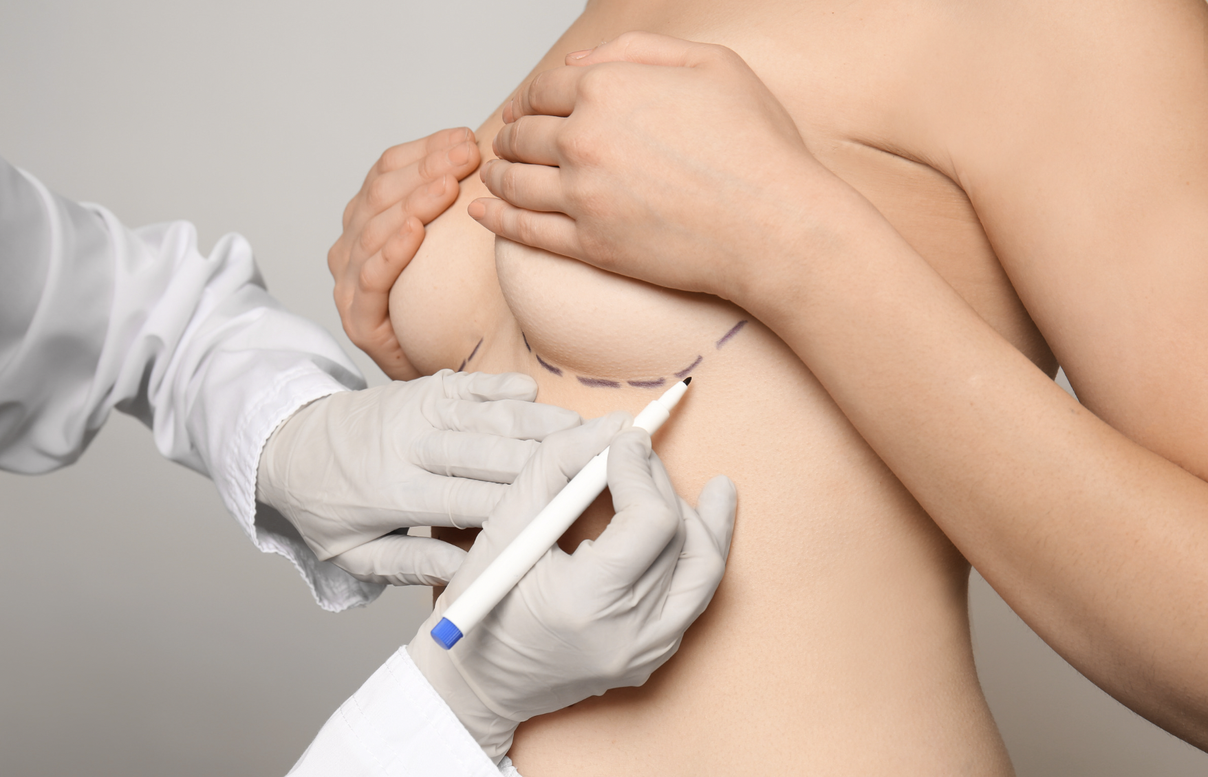 NYC Breast Augmentation