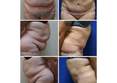 Abdominoplasty/Tummy Tuck with Liposuction