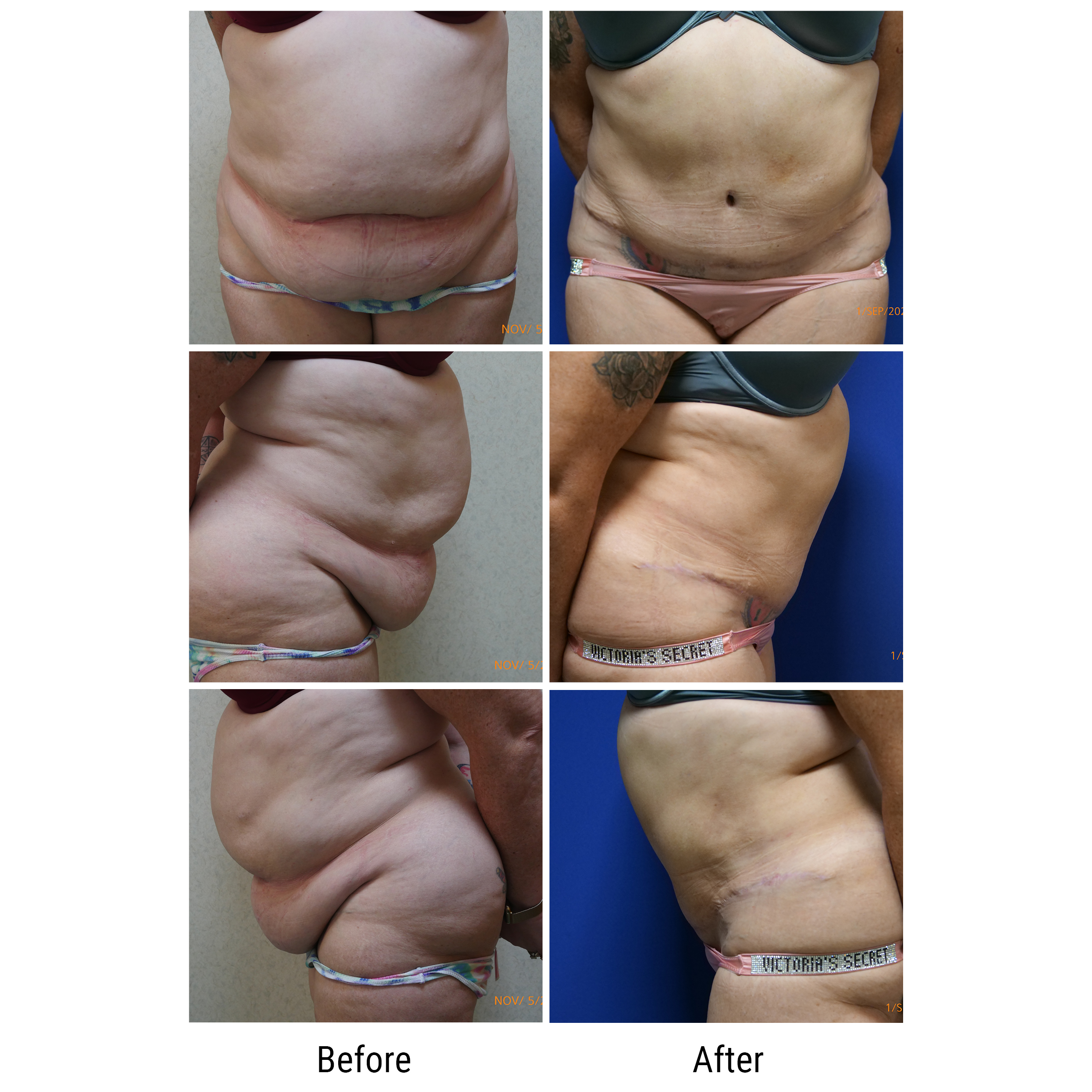 dermatology and surgery associates tummy tuck liposuction before and after bronx ny