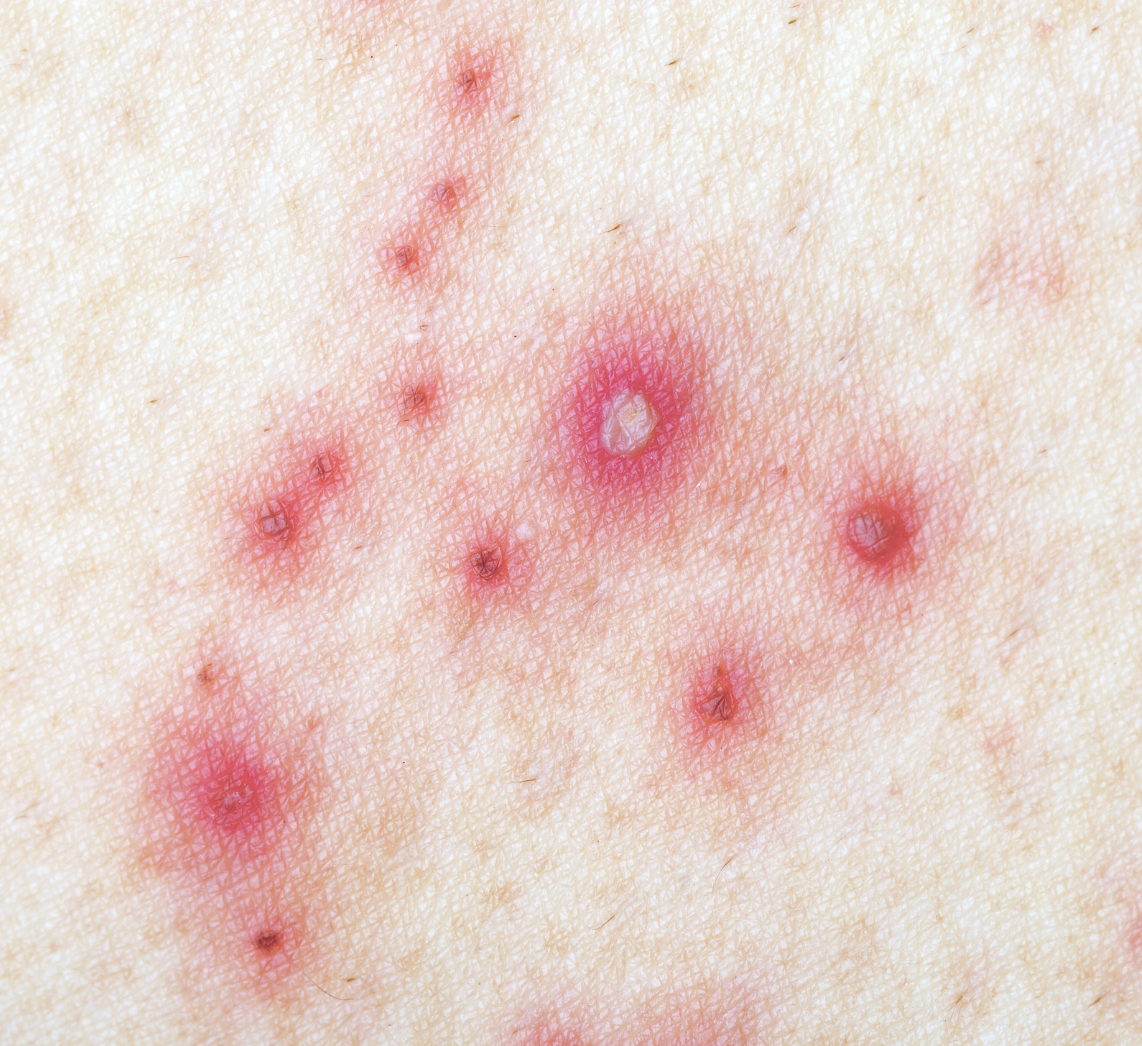 dermatology and surgery associates signs of herpes on skin bronx ny