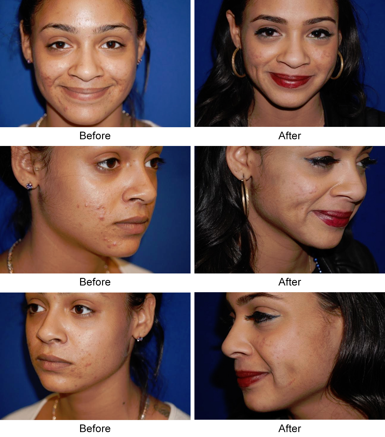 dermatology and surgery associates dimple surgery before and after bronx ny