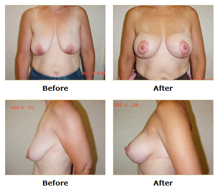 dermatology and surgery associates mommy makeover breast augmentation before and after bronx ny