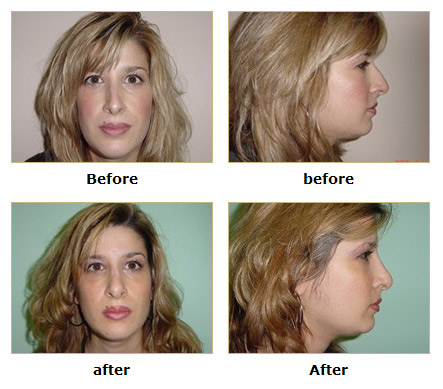 dermatology and surgery associates rhinoplasty before and after bronx ny