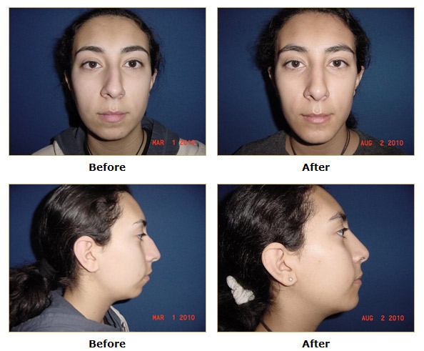 dermatology and surgery associates rhinoplasty before and after bronx ny