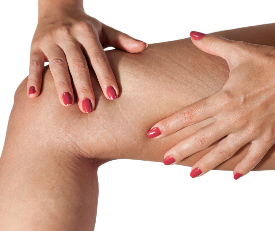 dermatology and surgery associates stretch marks on legs bronx ny