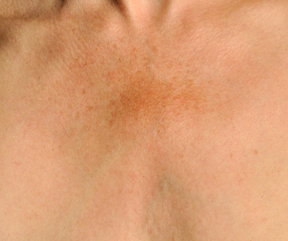 dermatology and surgery associates uneven skin tone on chest bronx ny