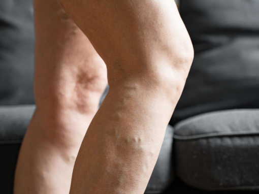 How to Prevent Leg Veins