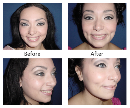 bronx plastic surgery close up of dimples bronx ny