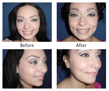 dermatology and surgery associates dimpleplasty before and after bronx ny