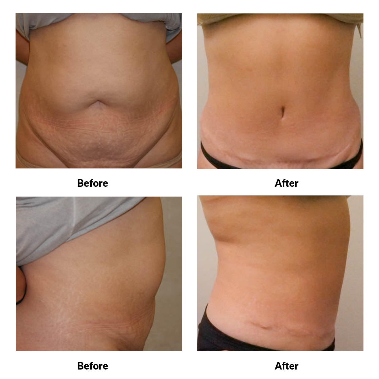 Keep Your Tummy Flat After a Tummy Tuck