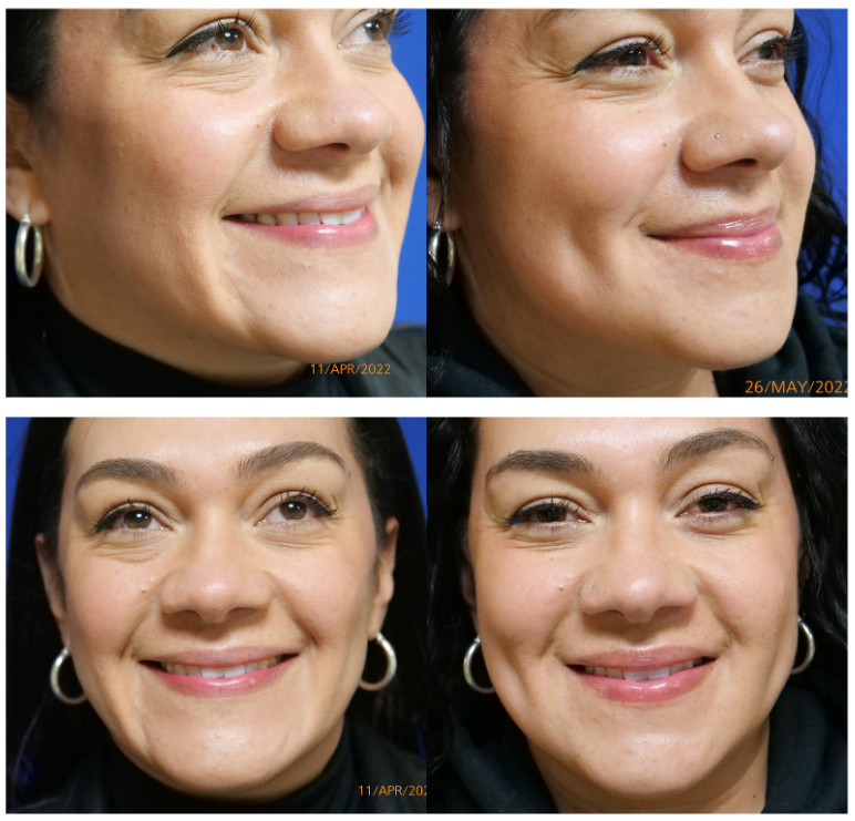 dermatology and surgery associates dimple surgery creation before and after bronx ny