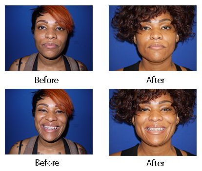 dermatology & surgery associates dimple plastic surgery before and after bronx ny