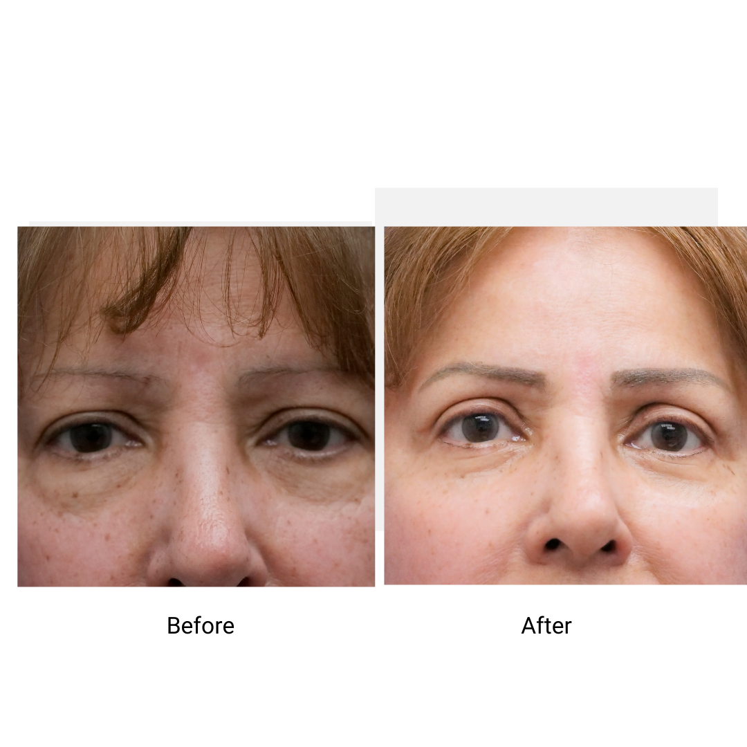 Eyelid Surgery Plastic Surgery Bronx, NYC